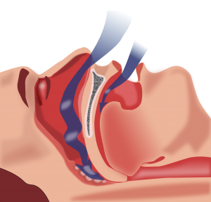 obstructive-sleep-apnoea