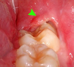 pericoronitis-wisdom-teeth-and-snoring