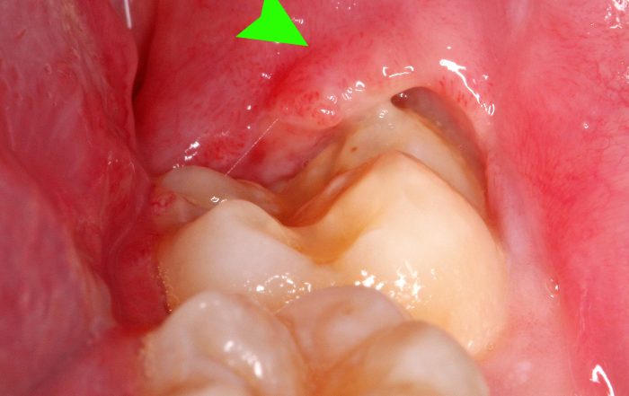 pericoronitis-wisdom-teeth-and-snoring